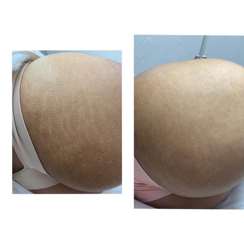 Tratamento para estrias