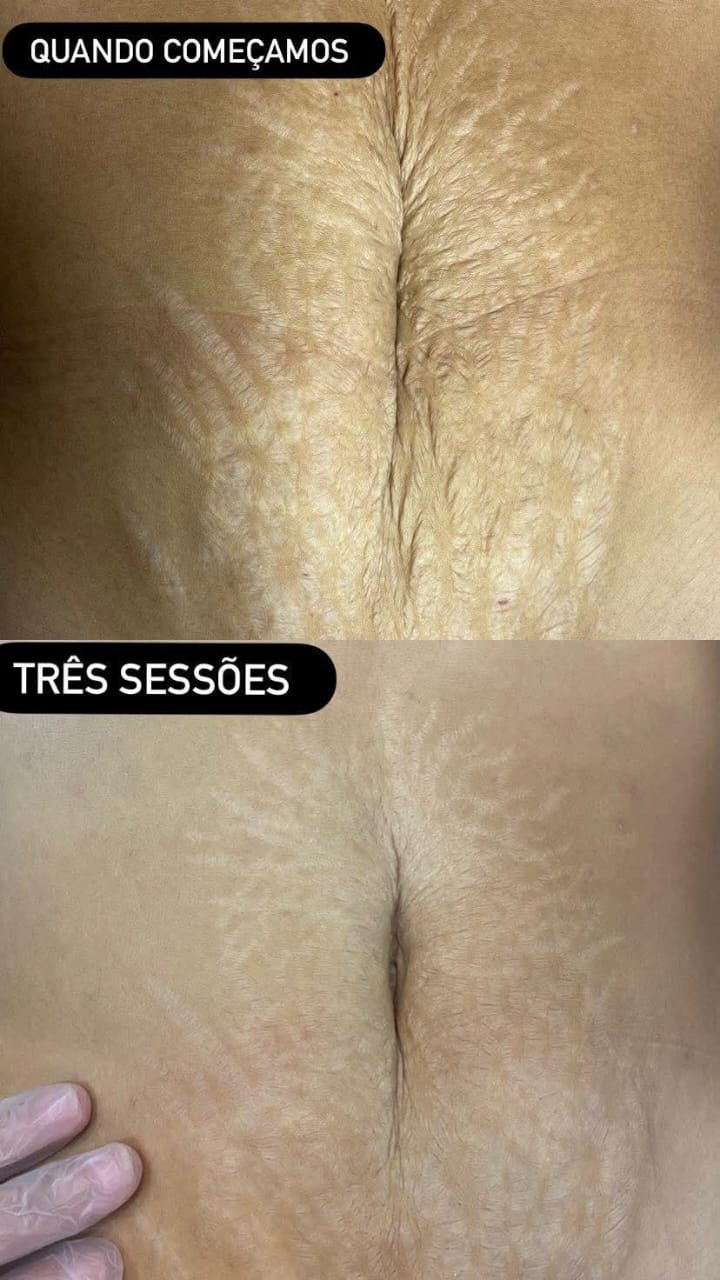 Tratamento para estrias