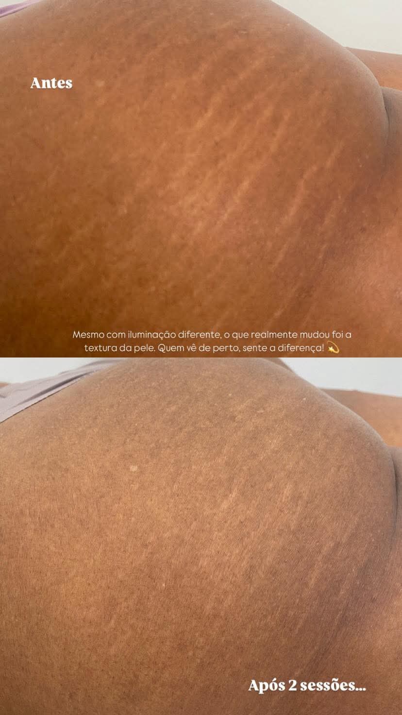 Tratamento para estrias